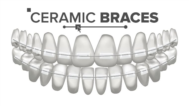 Ceramic Braces: Pros, Cons and All Types of Braces