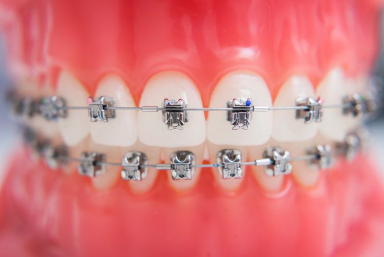 Self Ligating Braces - The Main Benefits and Downsides | MGA Dental ...